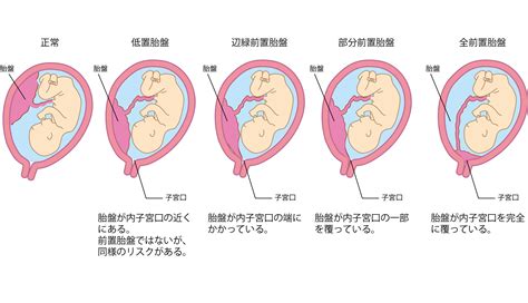 低位胎盤|低置胎盤